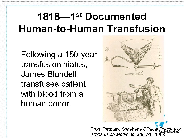 1818— 1 st Documented Human-to-Human Transfusion Following a 150 -year transfusion hiatus, James Blundell
