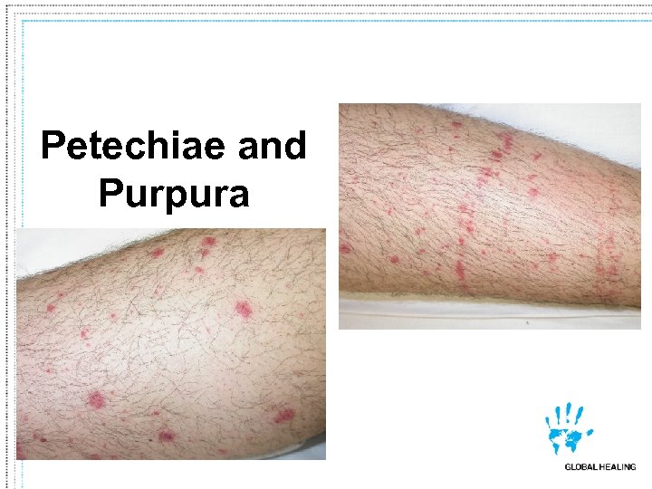 Petechiae and Purpura 