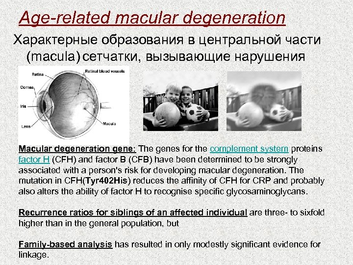 Age-related macular degeneration Характерные образования в центральной части (macula) сетчатки, вызывающие нарушения зрения Macular