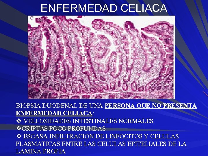 ENFERMEDAD CELIACA BIOPSIA DUODENAL DE UNA PERSONA QUE NO PRESENTA ENFERMEDAD CELIACA: v VELLOSIDADES