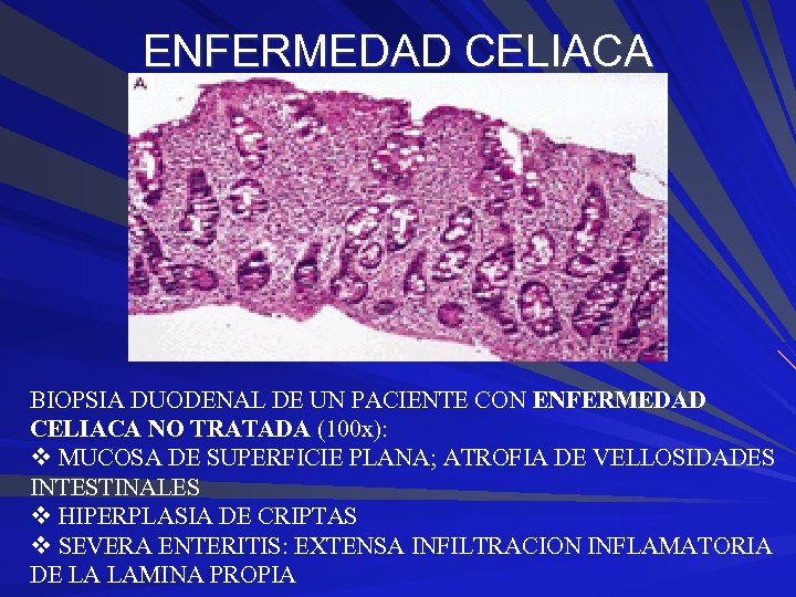 ENFERMEDAD CELIACA BIOPSIA DUODENAL DE UN PACIENTE CON ENFERMEDAD CELIACA NO TRATADA (100 x):