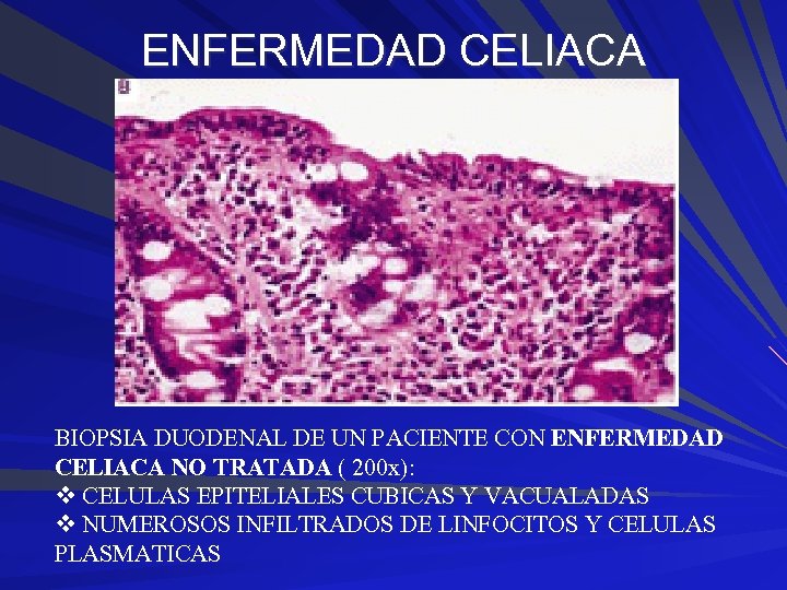 ENFERMEDAD CELIACA BIOPSIA DUODENAL DE UN PACIENTE CON ENFERMEDAD CELIACA NO TRATADA ( 200