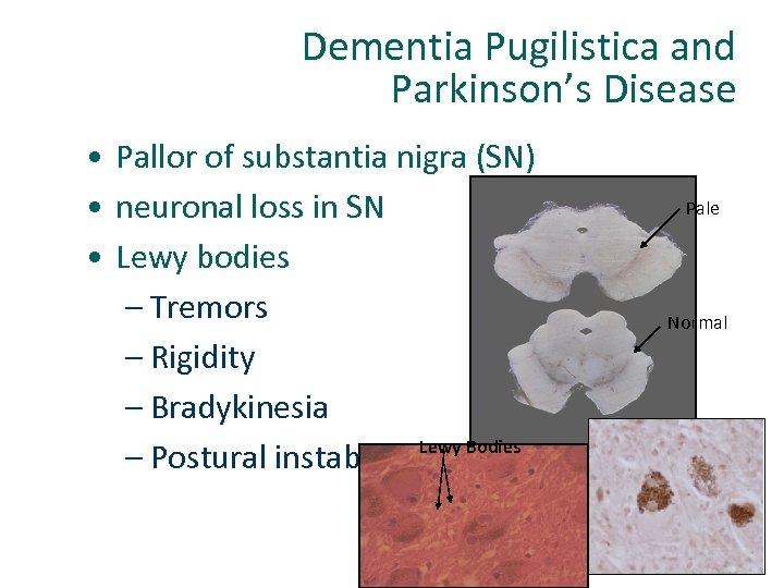  Dementia Pugilistica and Parkinson’s Disease • Pallor of substantia nigra (SN) • neuronal