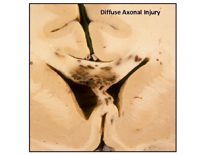 Diffuse Axonal Injury 