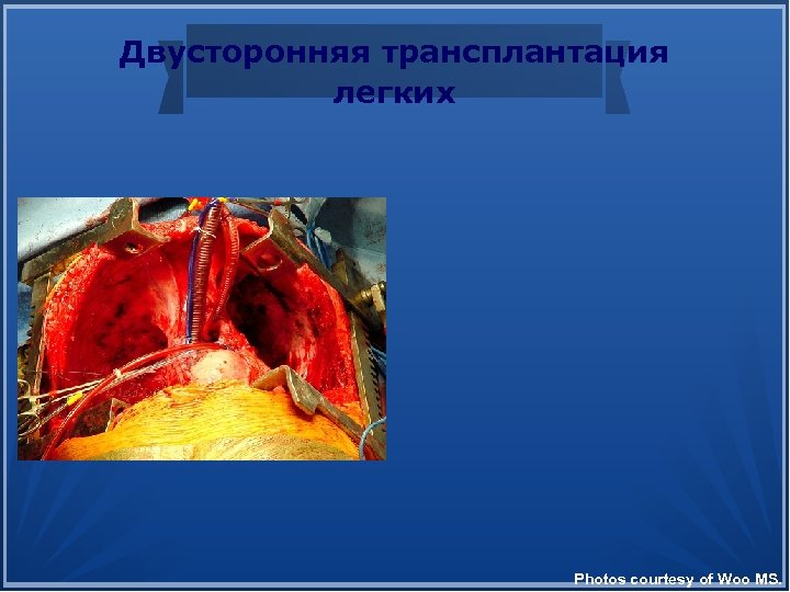 Двусторонняя трансплантация легких Photos courtesy of Woo MS. 