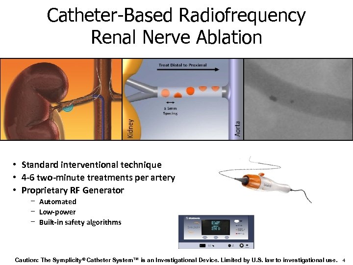Catheter-Based Radiofrequency Renal Nerve Ablation • Standard interventional technique • 4 -6 two-minute treatments