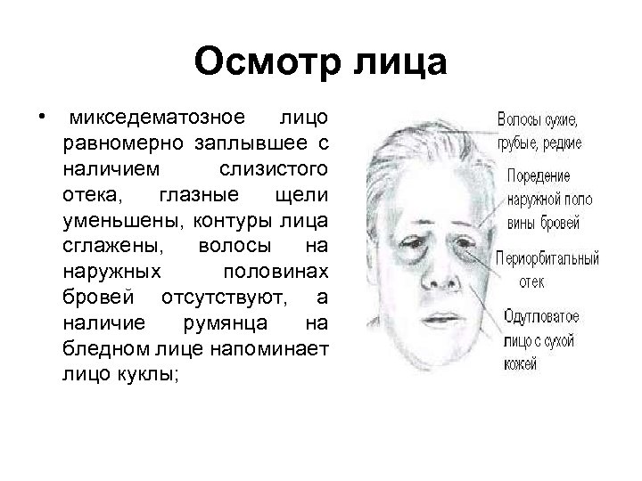Осмотр лица • микседематозное лицо равномерно заплывшее с наличием слизистого отека, глазные щели уменьшены,