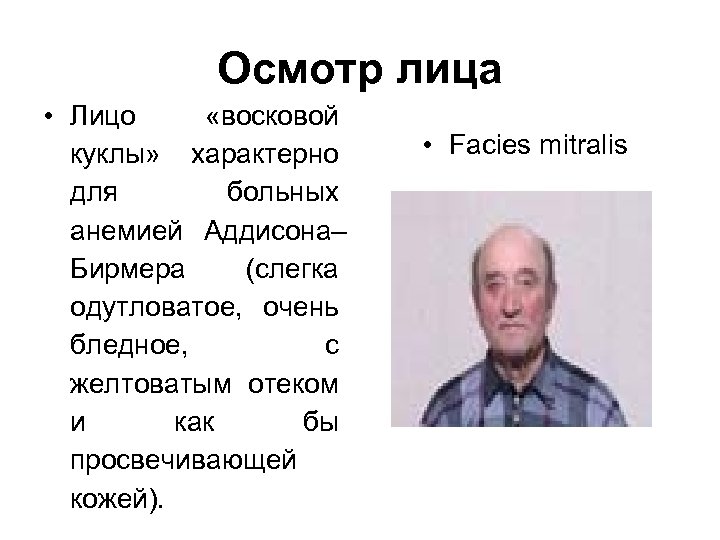 Осмотр лица • Лицо «восковой куклы» характерно для больных анемией Аддисона– Бирмера (слегка одутловатое,