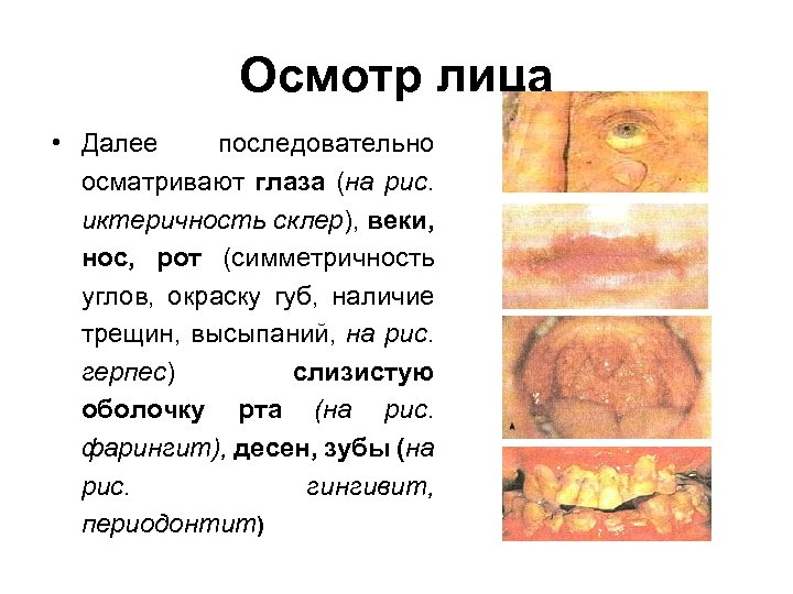 Осмотр лица • Далее последовательно осматривают глаза (на рис. иктеричность склер), веки, нос, рот