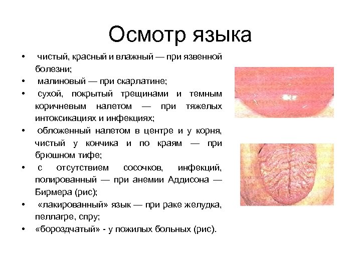 Осмотр языка • • чистый, красный и влажный — при язвенной болезни; малиновый —