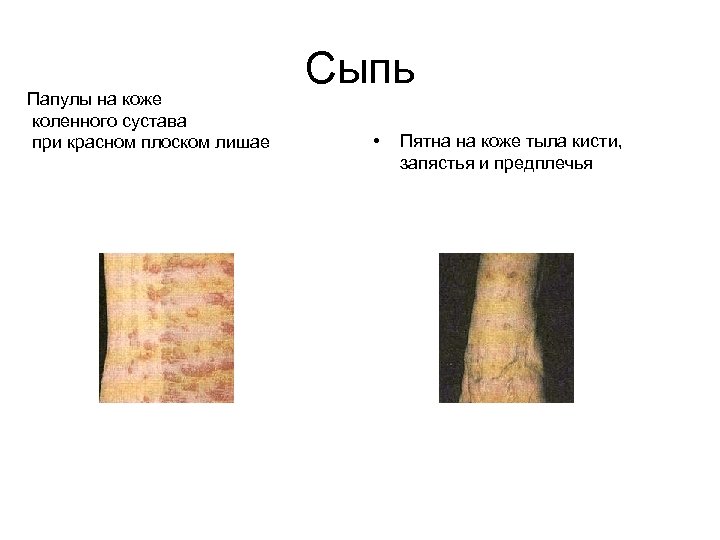 Папулы на коже коленного сустава при красном плоском лишае Сыпь • Пятна на коже