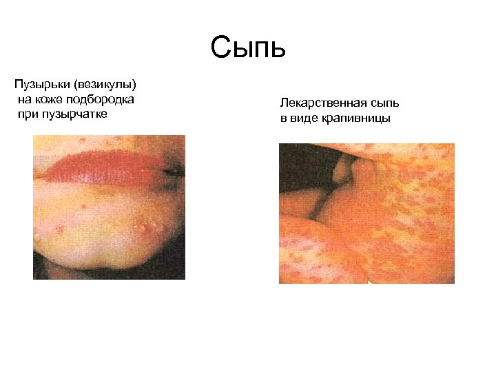 Сыпь Пузырьки (везикулы) на коже подбородка при пузырчатке Лекарственная сыпь в виде крапивницы 