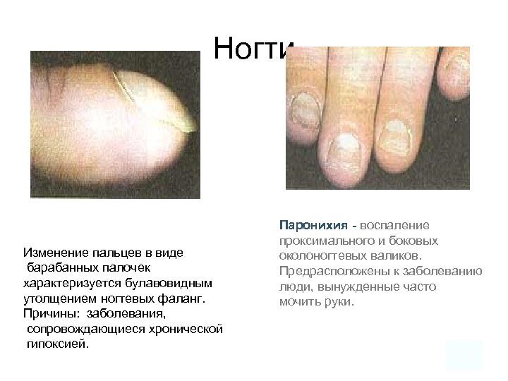 Ногти Изменение пальцев в виде барабанных палочек характеризуется булавовидным утолщением ногтевых фаланг. Причины: заболевания,