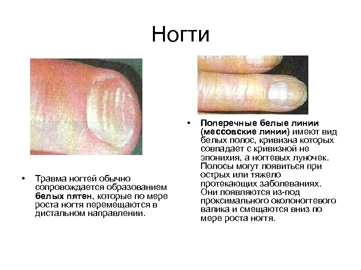 Ногти • • Травма ногтей обычно сопровождается образованием белых пятен, которые по мере роста