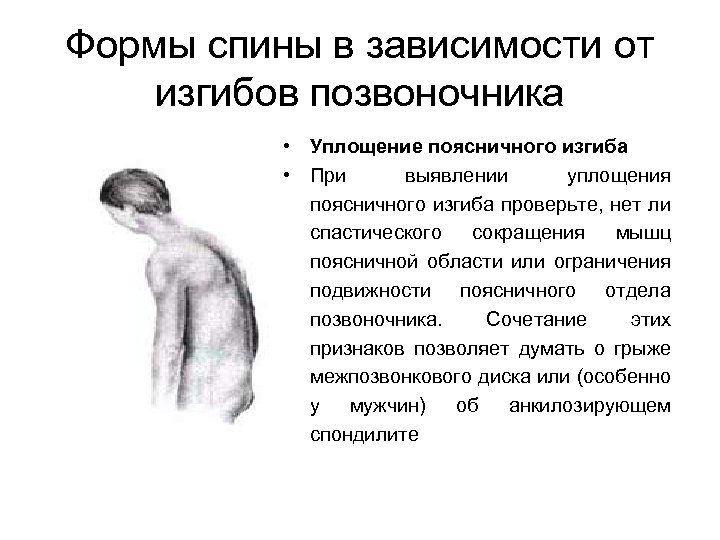 Формы спины в зависимости от изгибов позвоночника • Уплощение поясничного изгиба • При выявлении