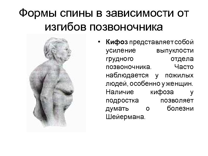 Формы спины в зависимости от изгибов позвоночника • Кифоз представляет собой усиление выпуклости грудного