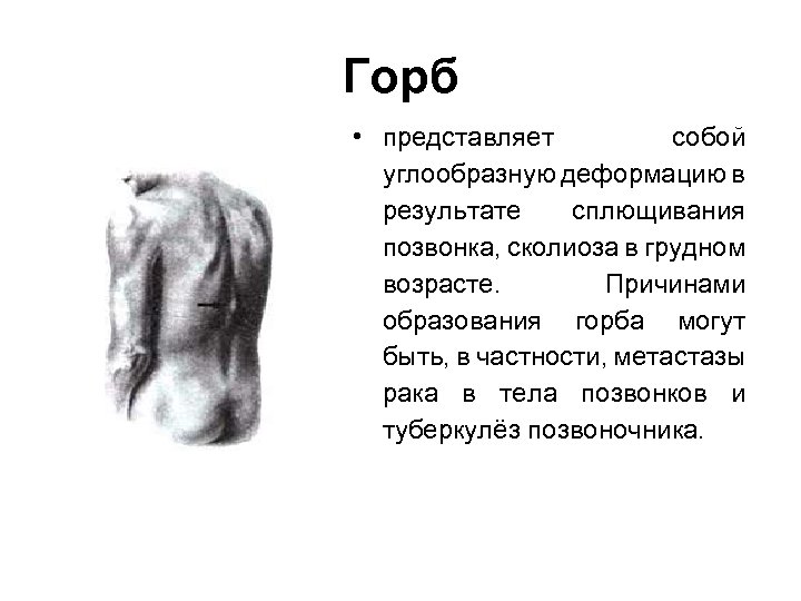 Горб • представляет собой углообразную деформацию в результате сплющивания позвонка, сколиоза в грудном возрасте.