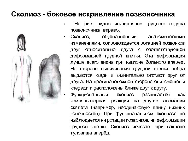 Сколиоз - боковое искривление позвоночника • • • На рис. видно искривление грудного отдела