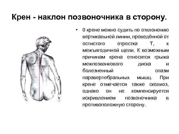 Крен - наклон позвоночника в сторону. • 0 крене можно судить по отклонению вертикальной