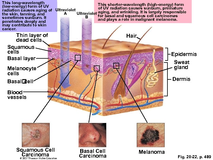 This long-wavelength This shorter-wavelength (high-energy) form (low-energy) form of UV radiation causes sunburn, premature