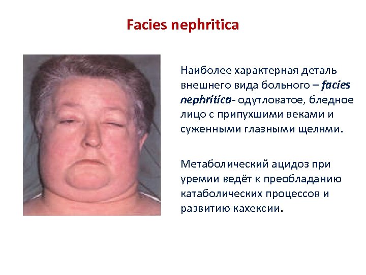 Facies nephritica Наиболее характерная деталь внешнего вида больного – facies nephritica- одутловатое, бледное лицо