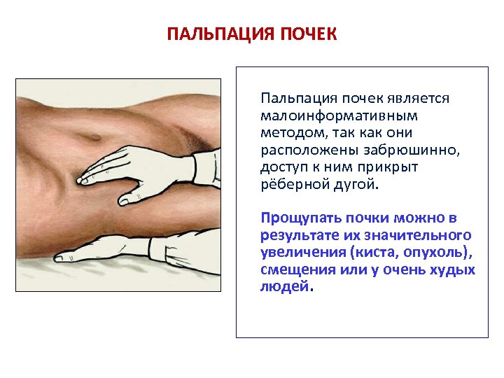 ПАЛЬПАЦИЯ ПОЧЕК Пальпация почек является малоинформативным методом, так как они расположены забрюшинно, доступ к