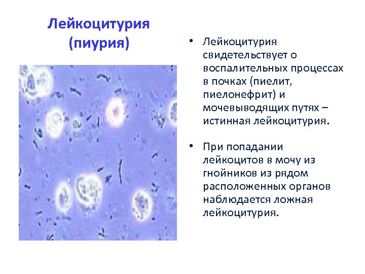 Лейкоцитурия (пиурия) • Лейкоцитурия свидетельствует о воспалительных процессах в почках (пиелит, пиелонефрит) и мочевыводящих