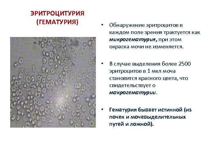 ЭРИТРОЦИТУРИЯ (ГЕМАТУРИЯ) • Обнаружение эритроцитов в каждом поле зрения трактуется как микрогематурия, при этом
