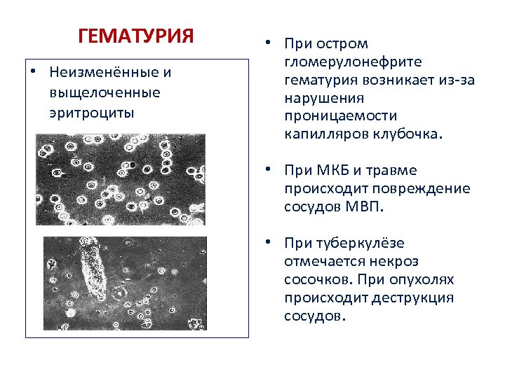 ГЕМАТУРИЯ • Неизменённые и выщелоченные эритроциты • При остром гломерулонефрите гематурия возникает из-за нарушения