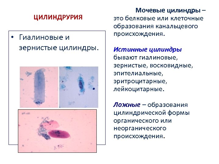 ЦИЛИНДРУРИЯ • Гиалиновые и зернистые цилиндры. Мочевые цилиндры – это белковые или клеточные образования