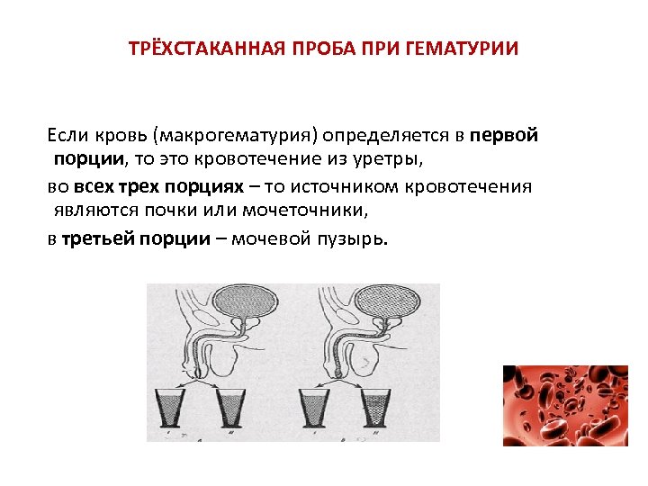 ТРЁХСТАКАННАЯ ПРОБА ПРИ ГЕМАТУРИИ Если кровь (макрогематурия) определяется в первой порции, то это кровотечение