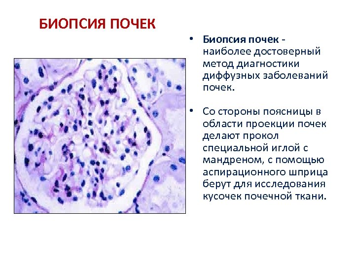БИОПСИЯ ПОЧЕК • Биопсия почек - наиболее достоверный метод диагностики диффузных заболеваний почек. •