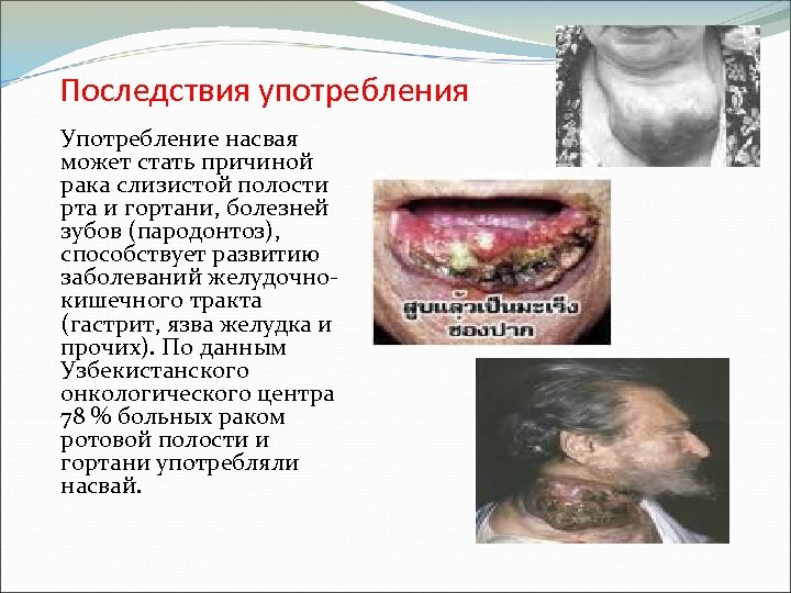 Последствия употребления Употребление насвая может стать причиной рака слизистой полости рта и гортани, болезней