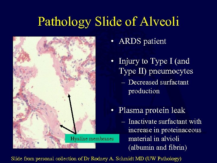 Pathology Slide of Alveoli • ARDS patient • Injury to Type I (and Type