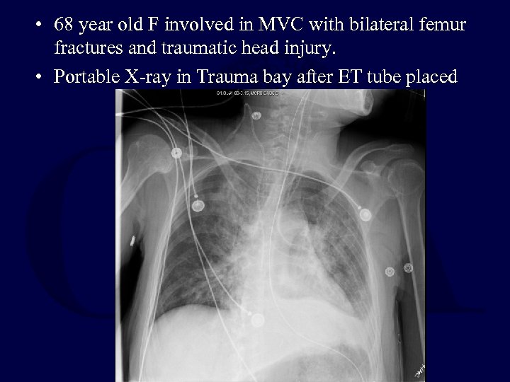  • 68 year old F involved in MVC with bilateral femur fractures and