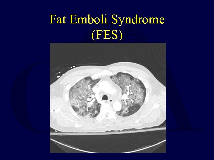 Fat Emboli Syndrome (FES) 