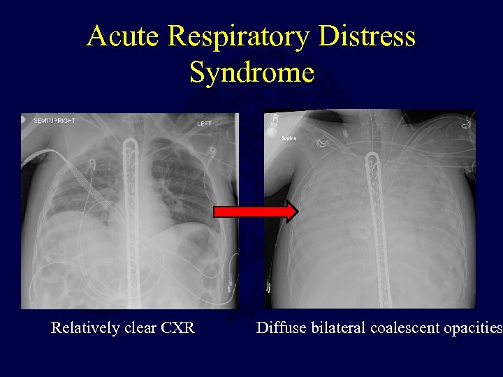 Acute Respiratory Distress Syndrome Relatively clear CXR Diffuse bilateral coalescent opacities 