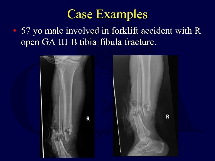 Case Examples • 57 yo male involved in forklift accident with R open GA