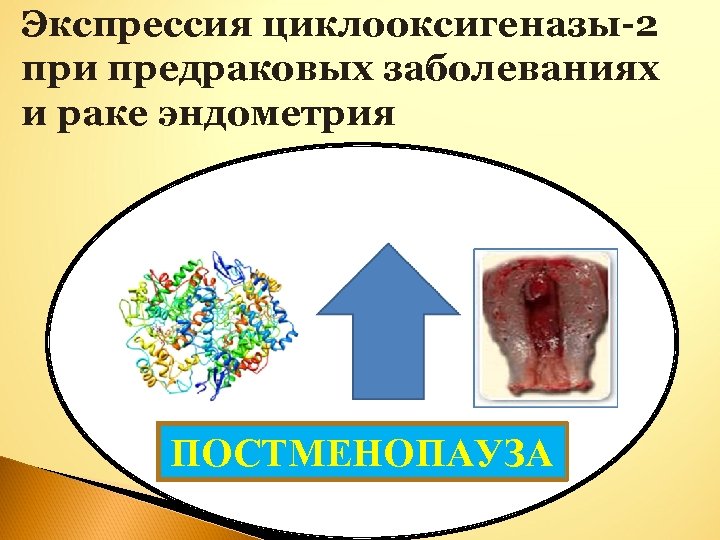 Экспрессия циклооксигеназы-2 при предраковых заболеваниях и раке эндометрия ПОСТМЕНОПАУЗА 