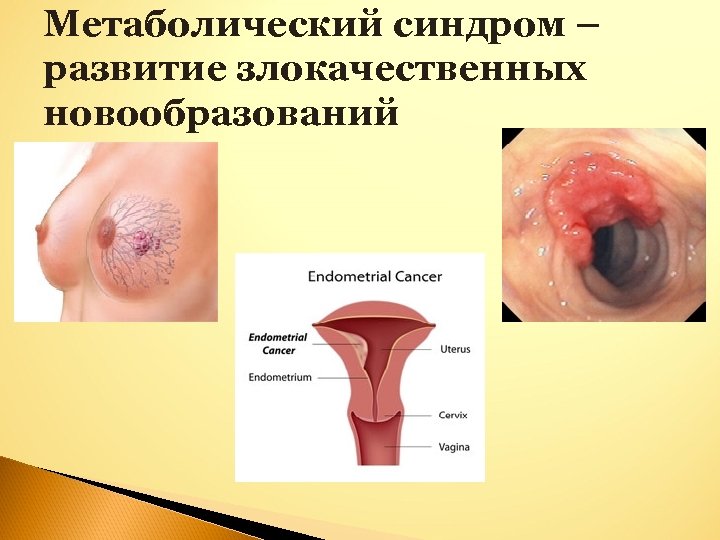 Метаболический синдром – развитие злокачественных новообразований 