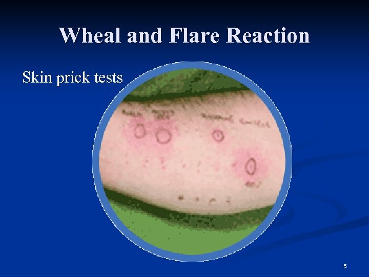 Wheal and Flare Reaction Skin prick tests 5 