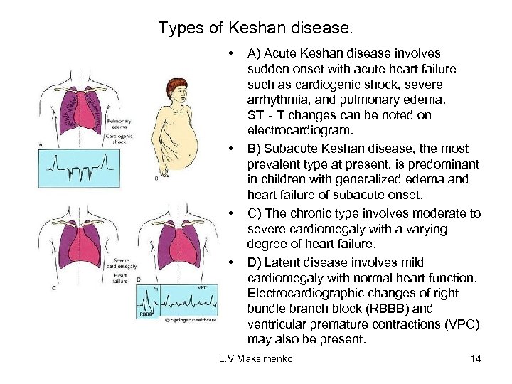 Types of Keshan disease. • • A) Acute Keshan disease involves sudden onset with