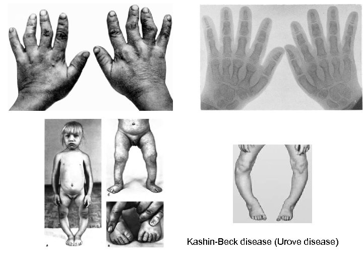 Kashin-Beck disease (Urove disease) 