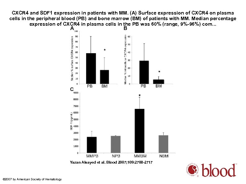 CXCR 4 and SDF 1 expression in patients with MM. (A) Surface expression of