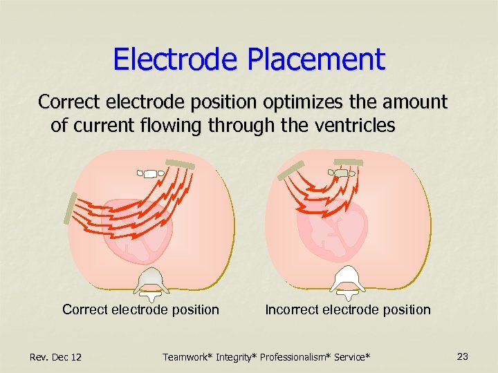 Electrode Placement Correct electrode position optimizes the amount of current flowing through the ventricles