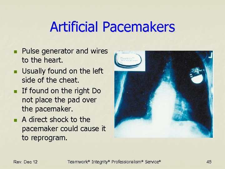 Artificial Pacemakers n n Pulse generator and wires to the heart. Usually found on