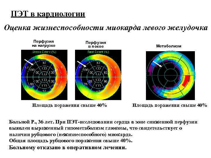 Пэт это. Позитронно-эмиссионная томография сердца. Позитронно-эмиссионная томография при инфаркте миокарда. ПЭТ ОФЭКТ миокарда.