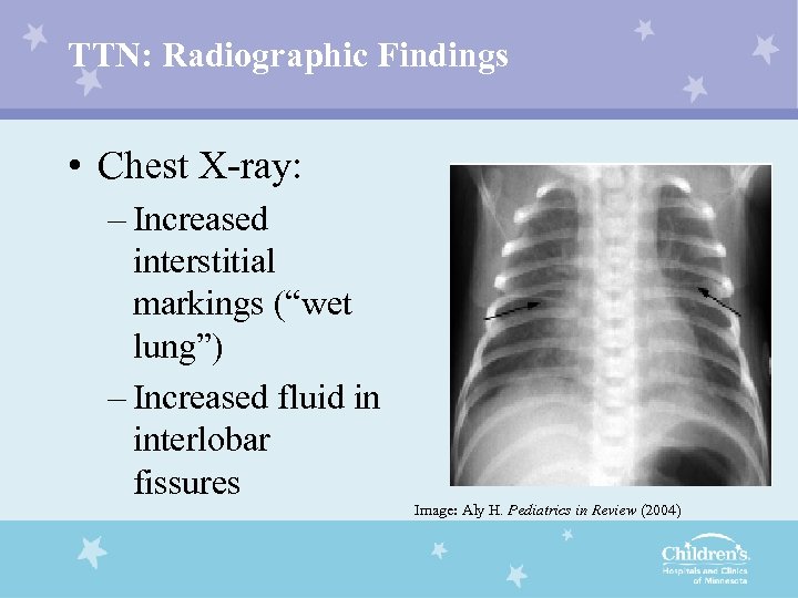 TTN: Radiographic Findings • Chest X-ray: – Increased interstitial markings (“wet lung”) – Increased