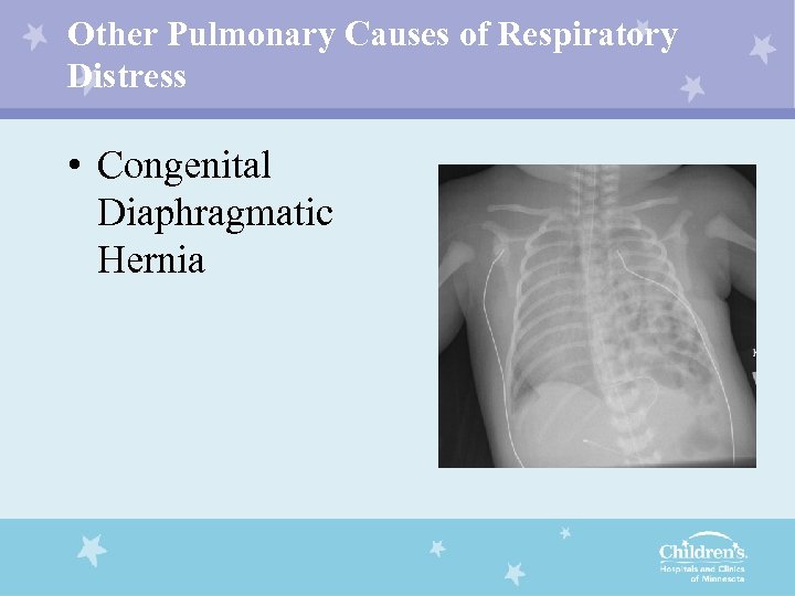 Other Pulmonary Causes of Respiratory Distress • Congenital Diaphragmatic Hernia 
