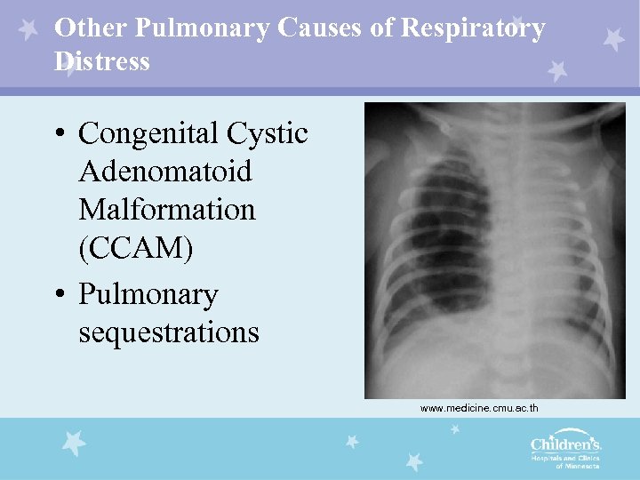 Other Pulmonary Causes of Respiratory Distress • Congenital Cystic Adenomatoid Malformation (CCAM) • Pulmonary